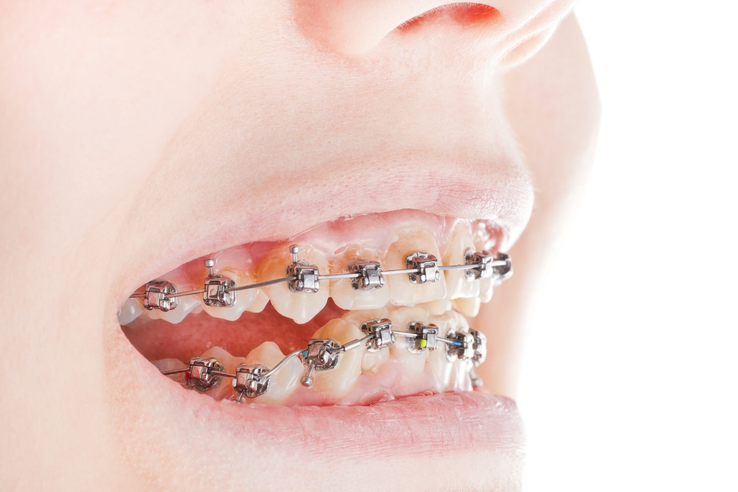 Braces to correct open bite