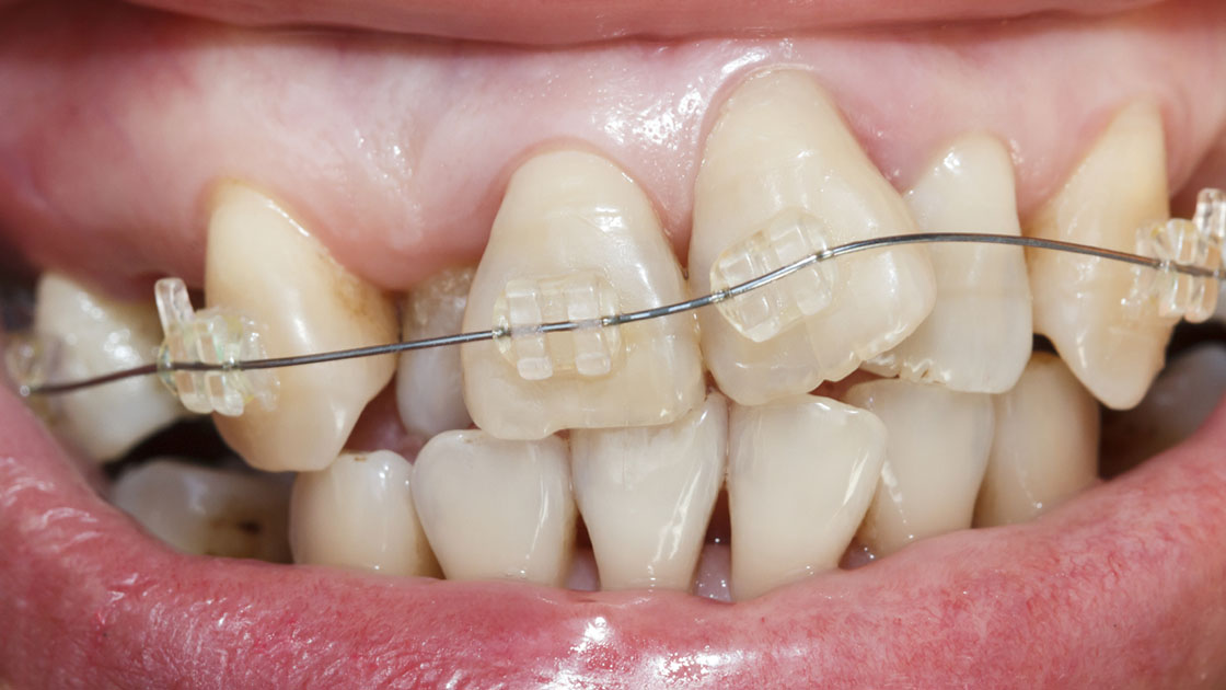 Braces to correct excessive crowding